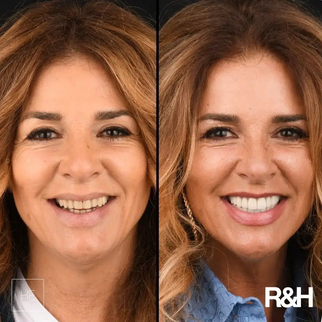 smile-transformation