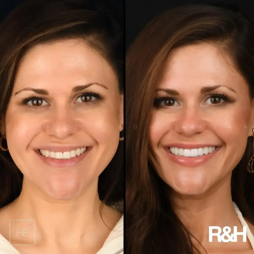 smile-transformation-composite